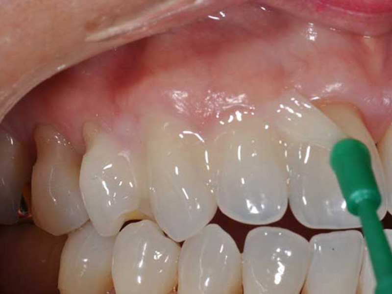 Fluoride Treatment on teeth