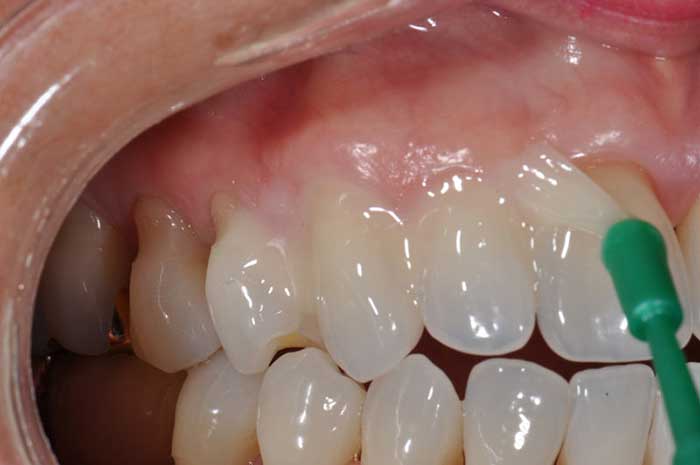 Fluoride teeth treatment in Edmonton, AB
