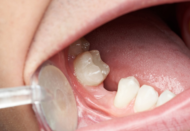 Tooth Replacement in in Edmonton, AB
